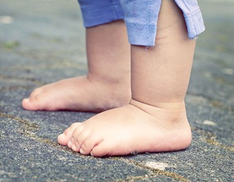 Mi hijo tiene los pies planos ¿debo preocuparme?