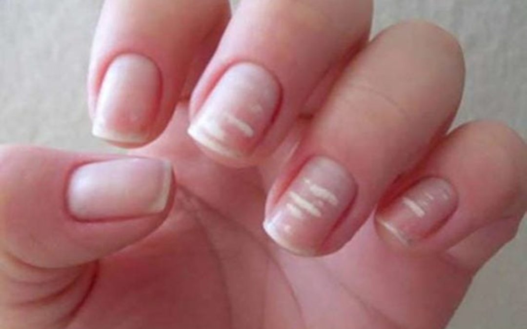 Manchas blancas en las uñas de los niños: qué debo saber