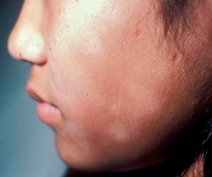 Pitiriasis alba: ¿qué debo saber?
